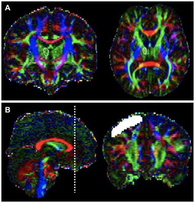 The integrity of thalamo-dorsolateral prefrontal cortex tract: a key factor in residual consciousness in disorders of consciousness patients